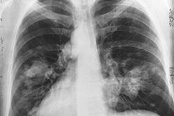 Local variations in lung cancer care