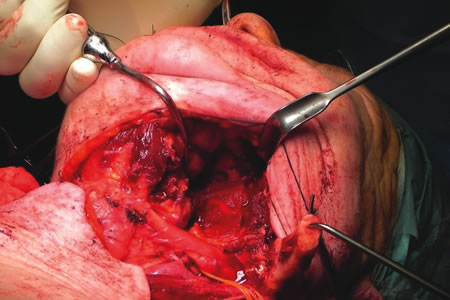 Achieving haemostasis without damaging tissue