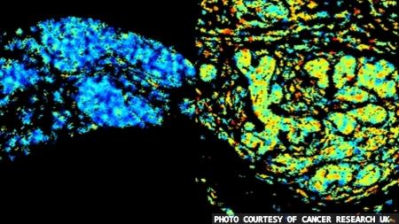 Imaging technique could help focus breast cancer treatment