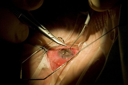 More fairness in cataract surgery called for