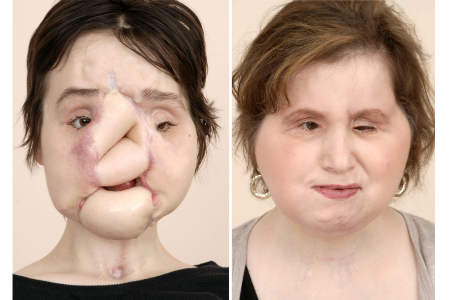 Woman receives total face transplant