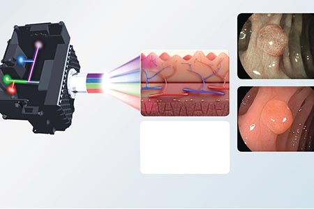 Endoscopic technology: Driving earlier detection