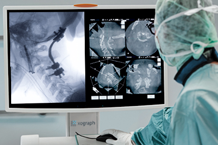 Spinal and orthopaedic surgery best outcomes aided by Ziehm 3D mobile C-arm