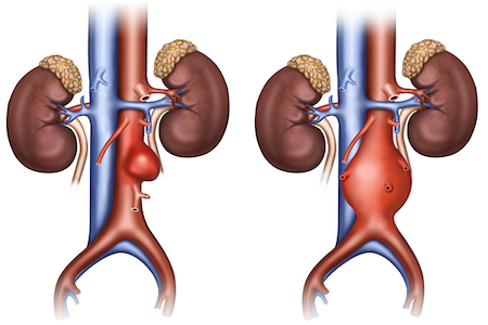 NICE publishes guideline on diagnosis and management of abdominal aortic aneurysms