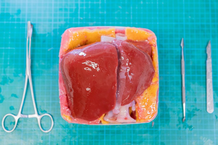 3D-printed liver to help surgeons prepare for life-saving operations