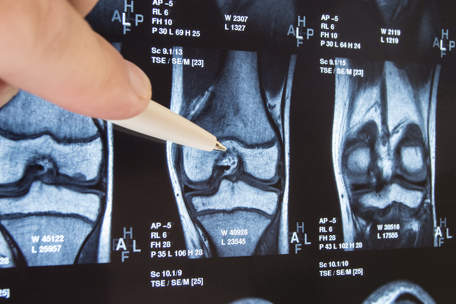 Study launched into robotic knee surgery 