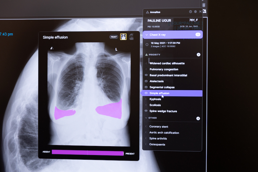 Study shows AI solution improves radiologist accuracy