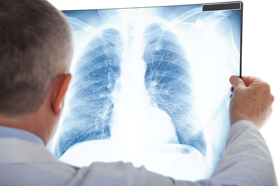 MHRA supports early access to treatment for advanced lung cancer