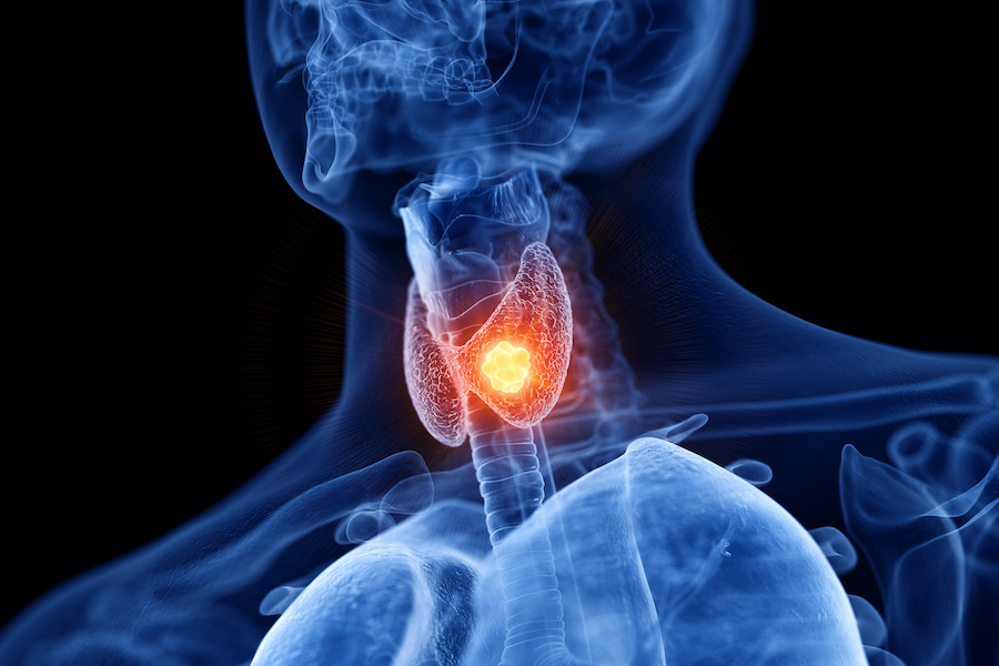 New drug available for rare thyroid cancer on NHS in England