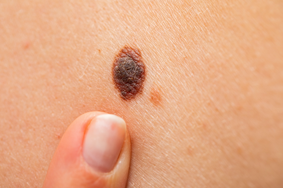 Consumer apps failing to correctly detect skin cancers 