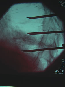 Percutaneous vertebroplasty reviewed