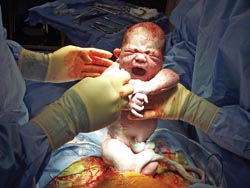 Infection concerns over Caesarean rise