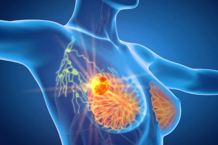 Decrease in women screened for breast cancer 