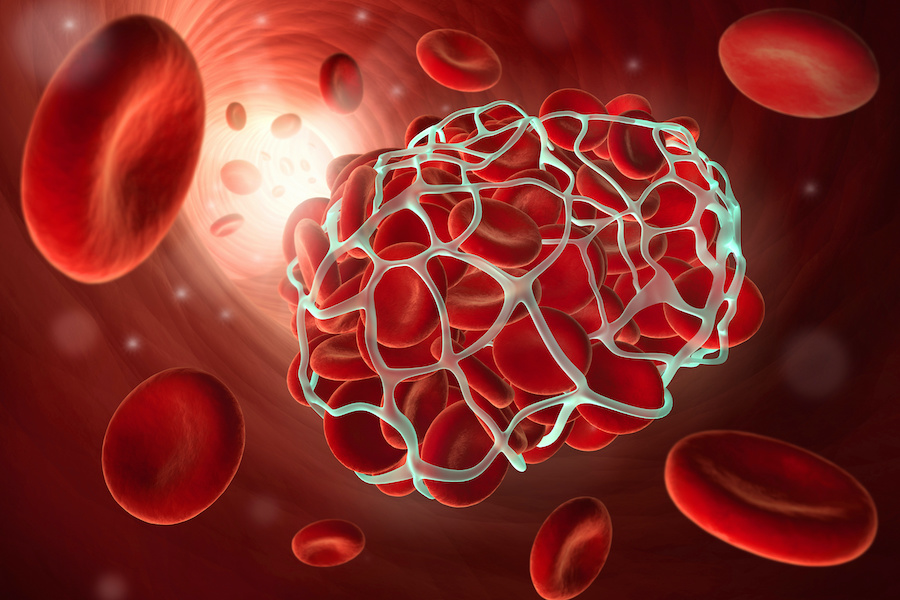 Study finds increased risk of serious blood clots up to six months after COVID-19