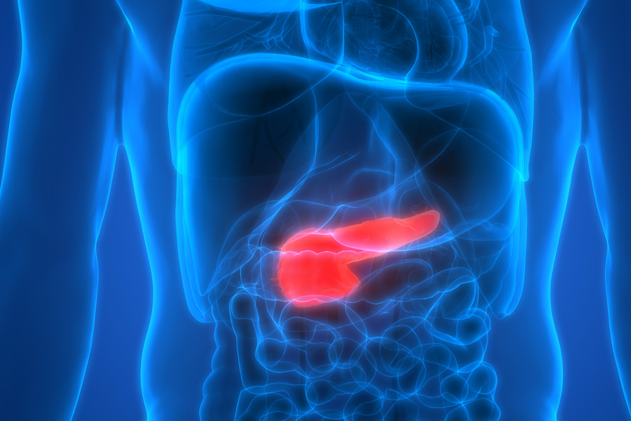 Gallstone disease shown to be strong predictor of pancreatic cancer