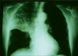 Old antibiotic could be new TB weapon