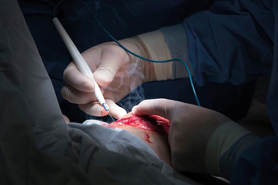 New report reveals risks of surgical plume