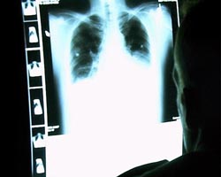 More effective staging for lung cancer patients