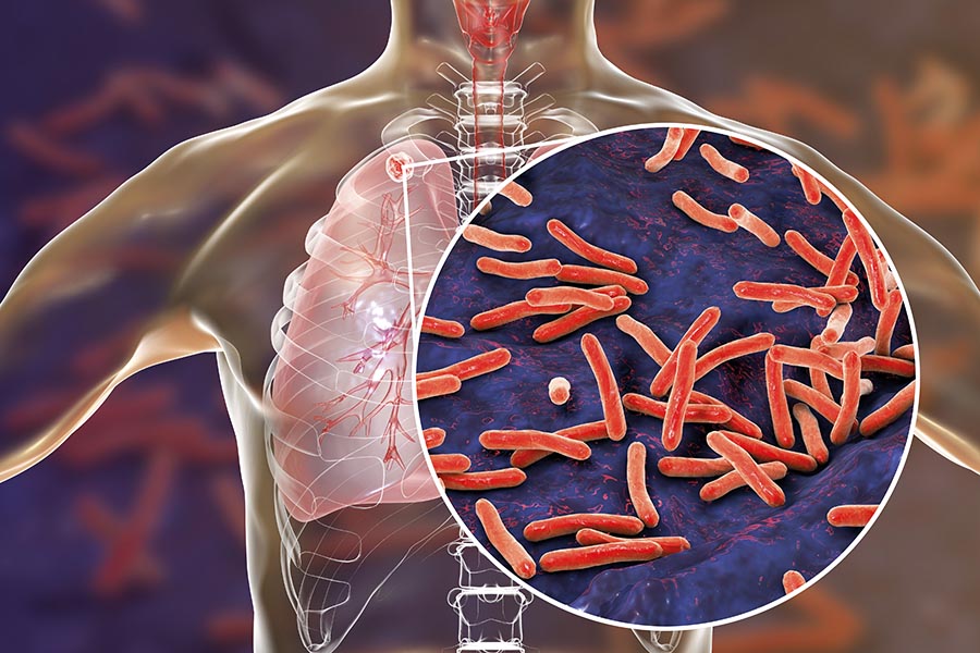 Common heartburn drugs could speed up tuberculosis treatment