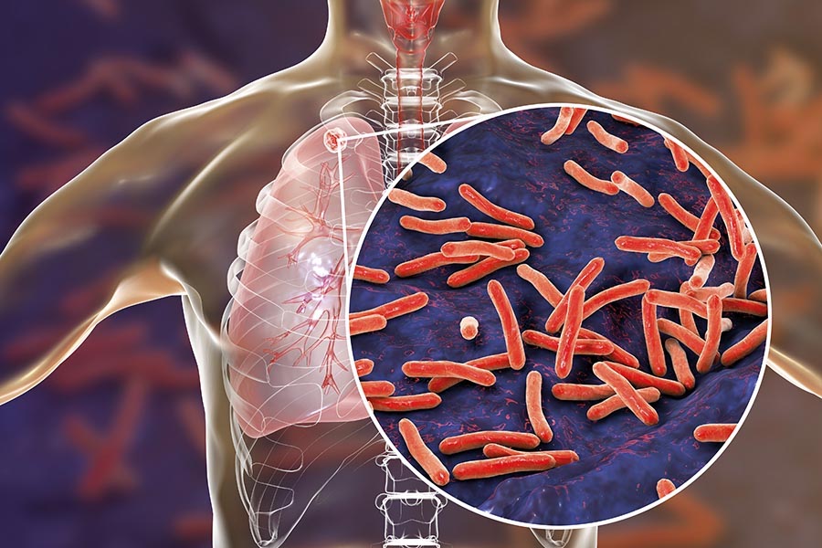 Calls to tackle tuberculosis in the European Region