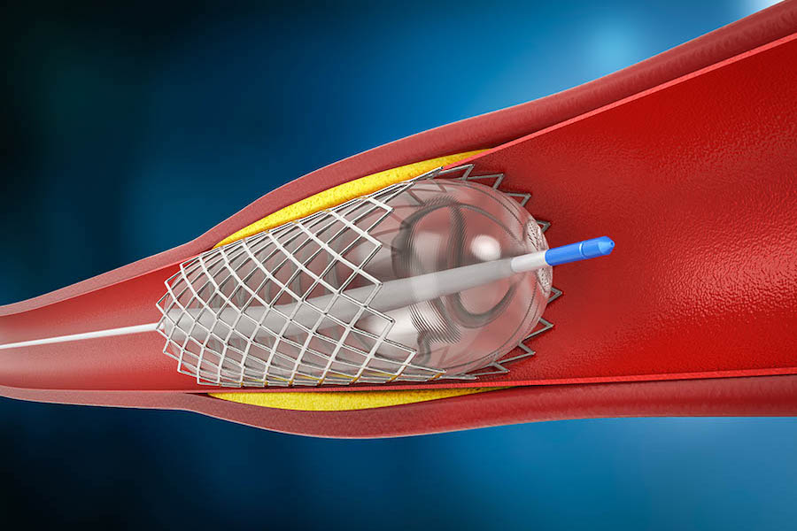 Complications for procedure to open clogged pulmonary arteries decrease significantly