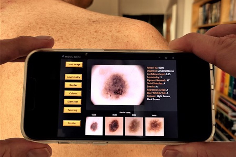 USW researchers working on app that could help GPs spot potential skin problems