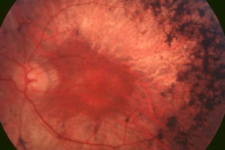 Blindness from some inherited eye diseases may be caused by gut bacteria