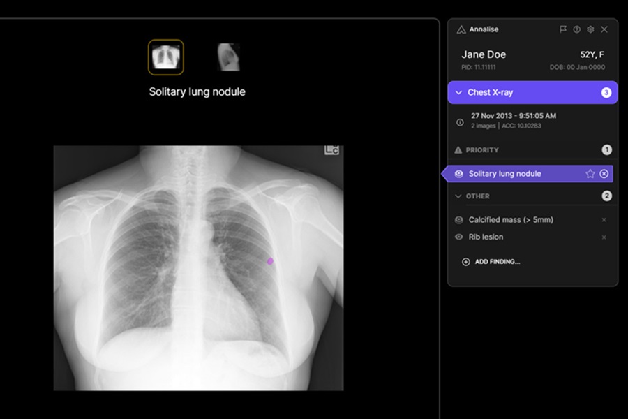 Significant breakthrough in UK's fight against lung cancer 