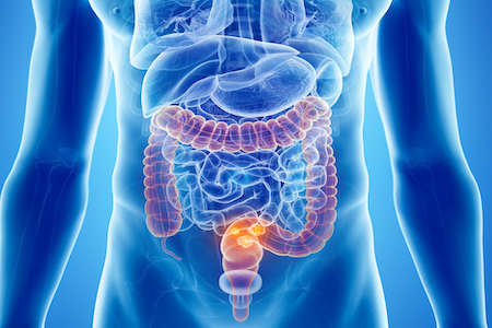 Immunotherapy significantly increases the number of patients free from bowel cancer