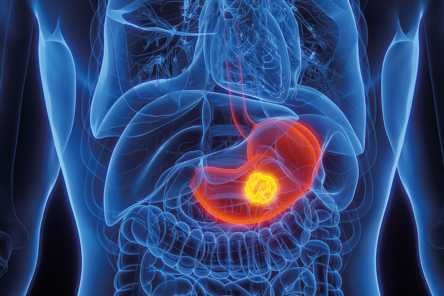 Identifying patients most at risk of gastric carcinogenesis