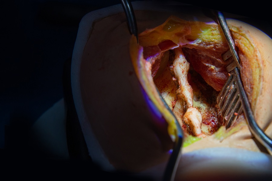 Inovus Medical and UpSurgeOn announce global partnership