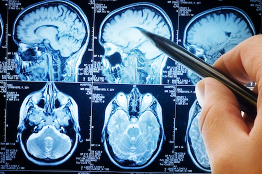 The COVID-19 pandemic may have aged our brains, according to a new study