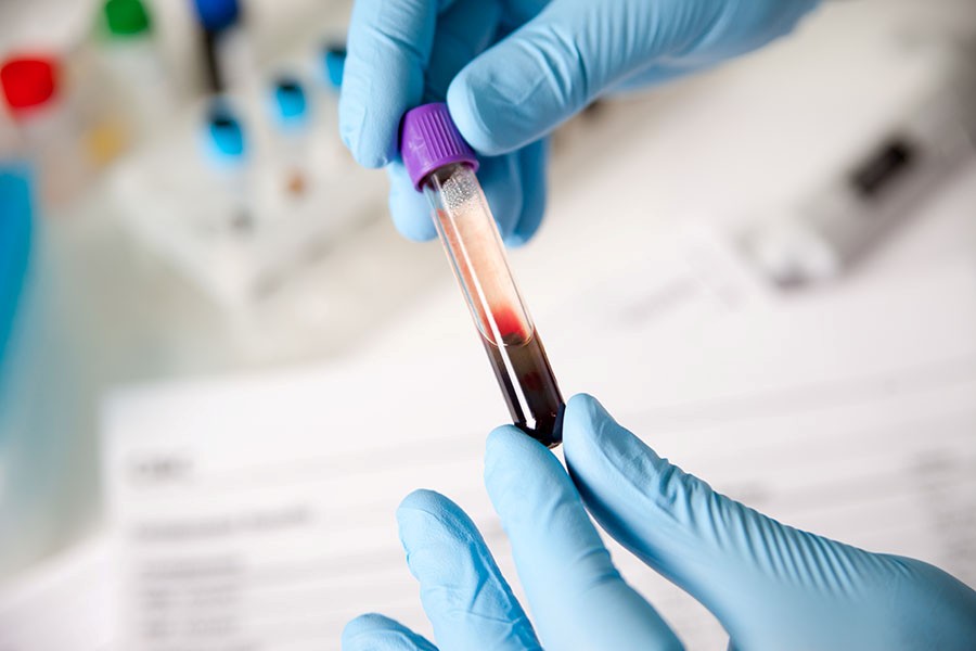 Roche receives CE Mark for minimally invasive blood test to help rule out Alzheimer’s disease