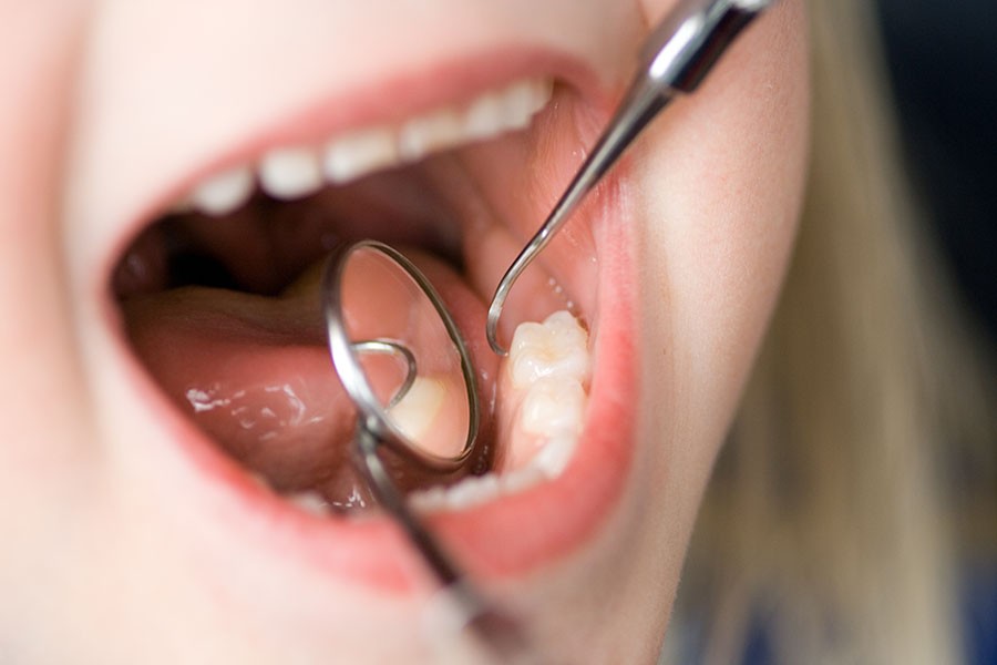 Tooth decay leading cause of hospital admissions among young children
